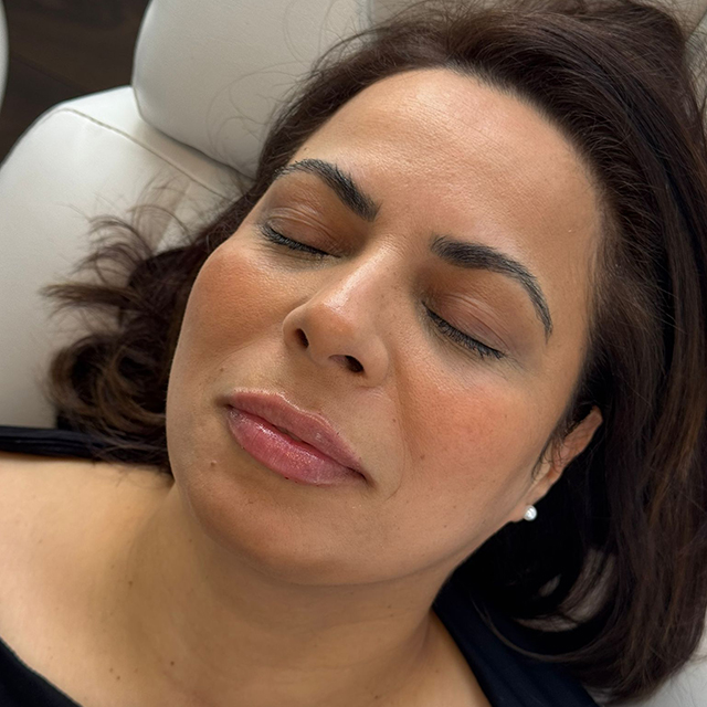 Filler nachher: Suna Kaya Beauty